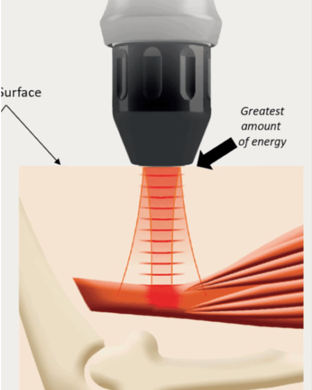 How Many Shockwave Therapy Sessions Do You Need?